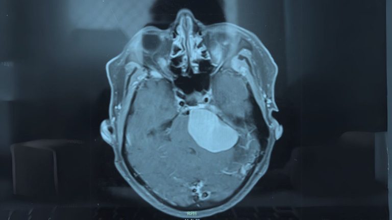 meningioma