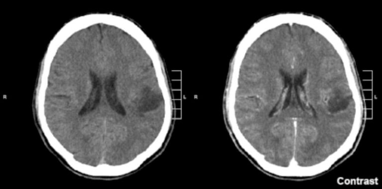 gliomas cerebrais