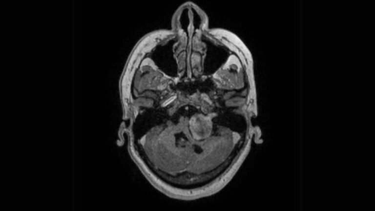 schwannoma ressonancia